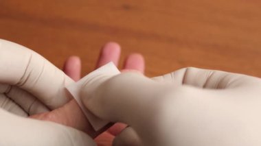 Eldeki yara dezenfeksiyon için alkol çözeltisiyle tedavi ediliyor. Küçük çaplı ev yaralanmaları.