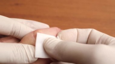 Eldeki yara dezenfeksiyon için alkol çözeltisi ile tedavi edilir ve alçı uygulanır. Küçük çaplı ev yaralanmaları.