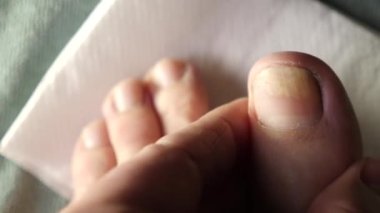 Tırnak boşluğu makasla temizlenmiş. Mantar tırnak hastalıklarının tedavisi.