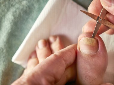 Tırnak boşluğu makasla temizlenmiş. Mantar tırnak hastalıklarının tedavisi.