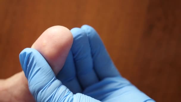 Medical Procedures Wart Finger Treated Alcohol Treatment Skin Diseases — Vídeos de Stock