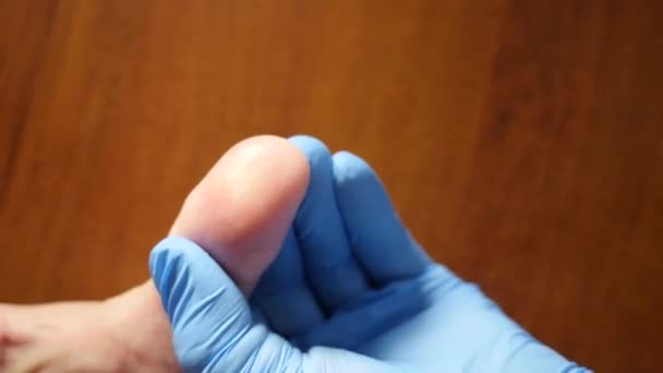 Ungüento Medicinal Aplica Dedo Con Verruga Tratamiento Enfermedades Piel — Vídeo de stock