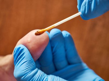 Tıbbi merhem siğilli parmağa sürülür. Deri hastalıklarının tedavisi.