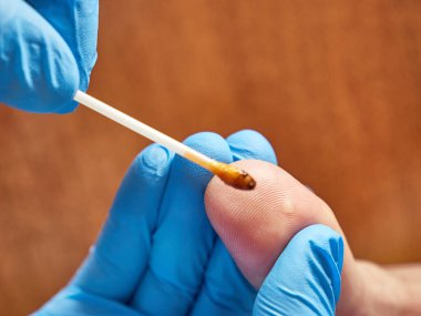 Medicinal ointment is applied to the wart of the thumb. Treatment of skin diseases.