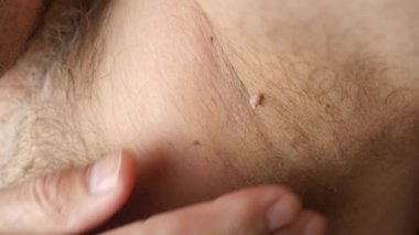 Large papilloma under the armpit of a man. Skin disease. Skin care.