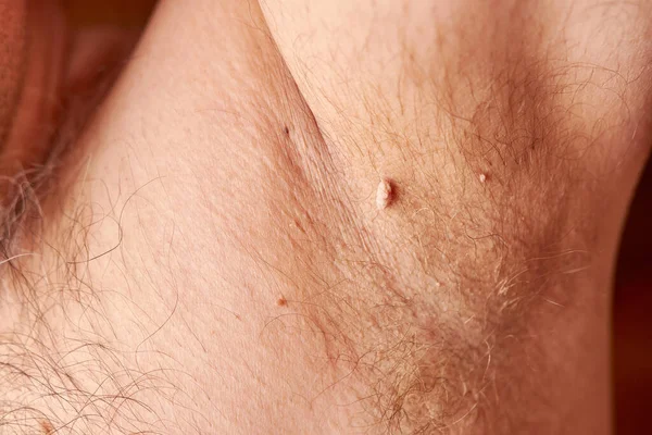 Large papilloma under the armpit of a man. Skin disease. Skin care.