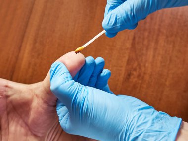 Tıbbi merhem siğilli parmağa sürülür. Deri hastalıklarının tedavisi.