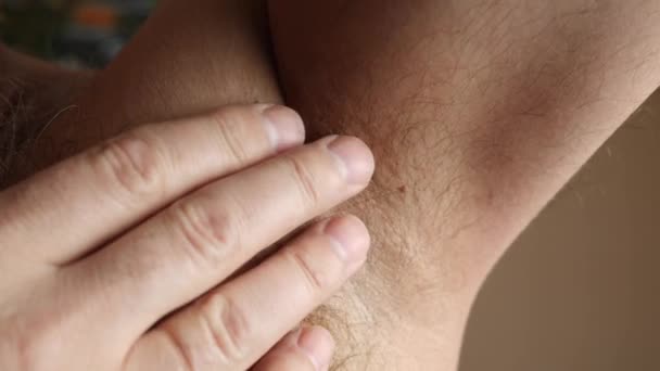 Large Papilloma Armpit Man Skin Disease Skin Care — Vídeo de Stock
