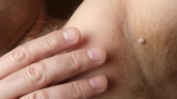 Large Papilloma Armpit Man Skin Disease Skin Care — ストック動画