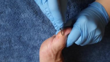 Doktor ayak parmağındaki hasarlı deriyi çıkarmak için cımbız kullanıyor..