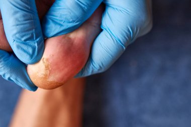 Doktor ayak parmağının hasarlı derisini inceliyor. Dermatolojik deri hastalıkları.