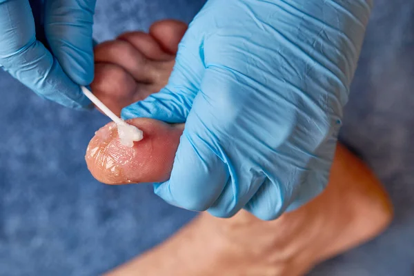 The doctor applies a healing ointment to the damaged skin of the toe.