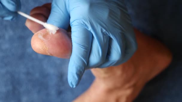 Doktor Ayak Parmağının Hasarlı Derisine Merhem Sürüyor — Stok video