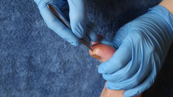 Γιατρός Χρησιμοποιεί Τσιμπιδάκι Για Αφαιρέσει Κατεστραμμένο Δέρμα Του Ποδιού — Αρχείο Βίντεο