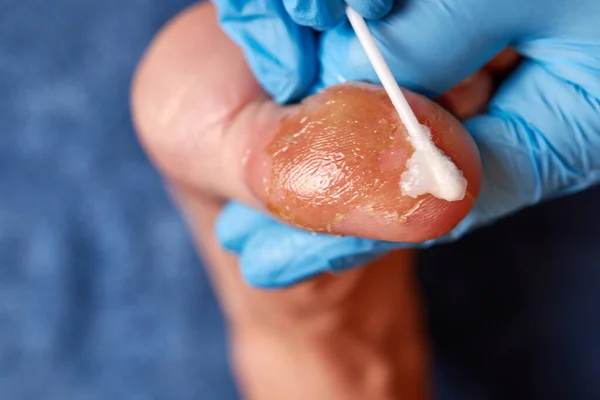 Treatment of skin diseases. The doctor applies a healing ointment to the damaged skin of the toe.