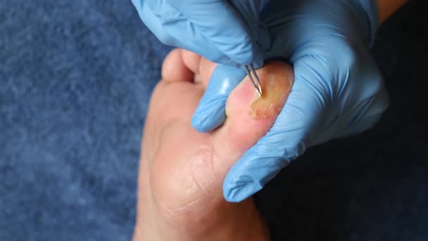 Лікар Використовує Пінцет Видалення Пошкодженої Шкіри Пальці Ніг — стокове відео