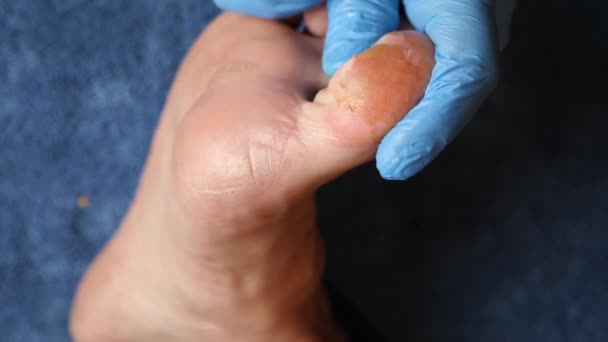 Γιατρός Χρησιμοποιεί Τσιμπιδάκι Για Αφαιρέσει Κατεστραμμένο Δέρμα Του Ποδιού — Αρχείο Βίντεο