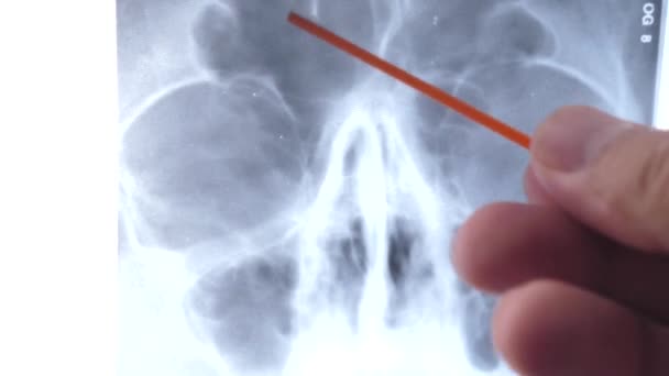Estudia Una Radiografía Los Senos Maxilares Inflamación Los Senos Maxilares — Vídeo de stock