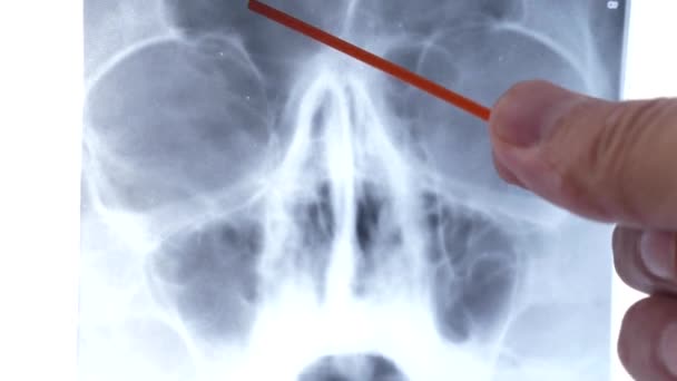Estudia Una Radiografía Los Senos Maxilares Inflamación Los Senos Maxilares — Vídeo de stock