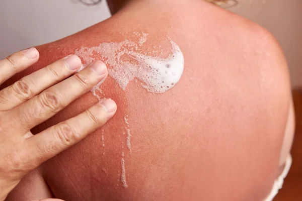 The foam is applied to sun-damaged areas of the skin. Sunburns on the skin. Body skin care. Protection against excessive sunburn and skin irritation.