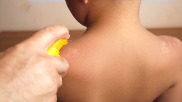 泡沫应用于皮肤的晒伤部位 皮肤上晒黑了 身体皮肤护理 防止过度晒伤和皮肤刺激 — 图库视频影像