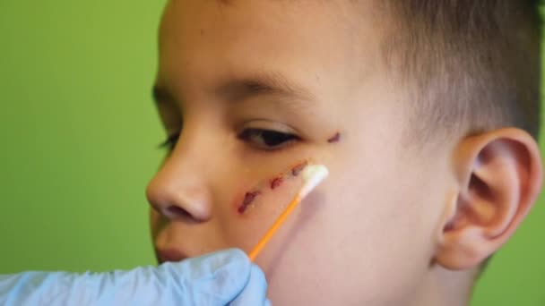 Såret Pojkens Ansikte Behandlas Med Pantenolskum Behandling Och Läkning Repor — Stockvideo