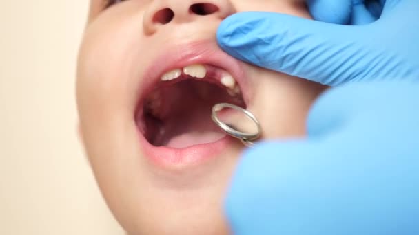 Лікар Вивчає Ротову Порожнину Дитини Відсутнім Зубом Допомогою Стоматологічного Дзеркала — стокове відео