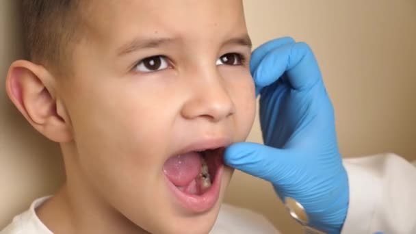 医師は歯鏡を使って行方不明の歯を持つ子供の口腔を調べます ヘルスケアと歯科医療のコンセプト — ストック動画