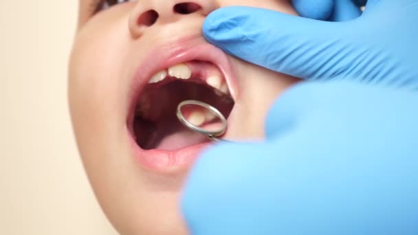 医師は歯鏡を使って行方不明の歯を持つ子供の口腔を調べます 医療と歯科医療のコンセプト スローモーション — ストック動画