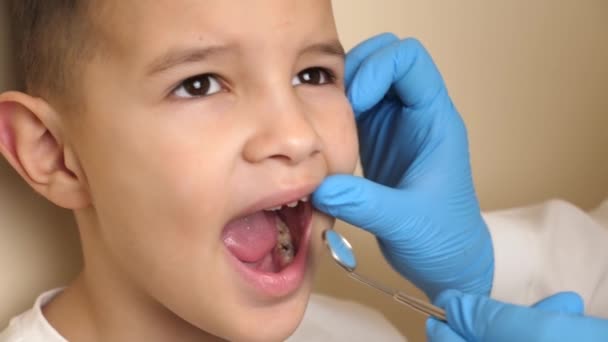 Lekarz Bada Jamy Ustnej Dziecka Brakującym Zębem Pomocą Lusterka Dentystycznego — Wideo stockowe