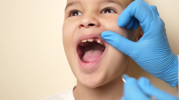 医師は歯鏡を使って行方不明の歯を持つ子供の口腔を調べます 医療と歯科医療のコンセプト スローモーション — ストック動画