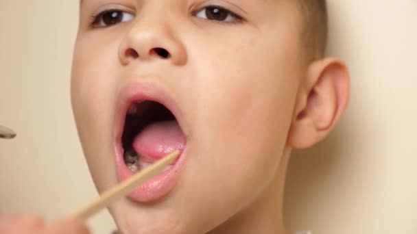医生用牙镜和木片对缺牙齿儿童的口腔进行检查 保健和牙科护理概念 — 图库视频影像