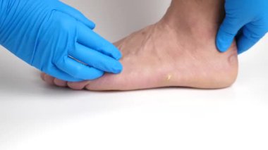 Bir doktor bir adamın ayağında nasırları muayene eder. Ayakta nasır tedavisi.