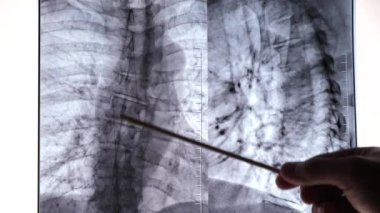 Doktor hasarlı omurganın röntgenini inceler. Omurga, skolyoz ve sifoz hastalıklarının tedavisi ve önlenmesi.