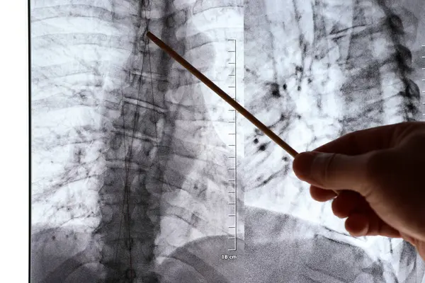 stock image A doctor examines an X-ray image of a curved spine. Treatment and prevention of diseases of the spine, scoliosis, syphosis.