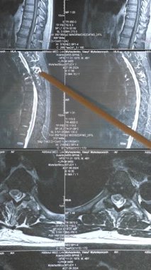 Doktorlar omurganın MR görüntüsünü analiz ediyor. Hastalıkların teşhis yöntemleri ve omurga patolojileri..