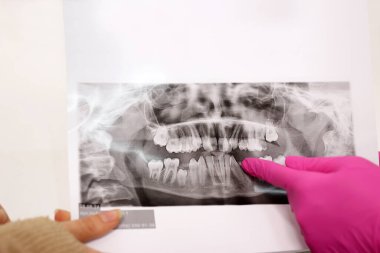 Diş hekimi hastaya dişlerin röntgenini gösterir, tedavi yöntemini belirler. Diş hekimliği kavramı.
