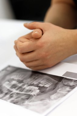 Diş hekimi dişlerin panoramik röntgenini inceler ve tedavi yöntemini belirler. Diş hekimliği kavramı.