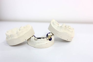 Alt çeneli diş kalıbı. Taçlar, köprüler, kaplamalar, yüksek hassasiyetli takma dişler ve parantez sistemleri gibi bireysel diş yapıları üretmek amacıyla diş kemerinin bir taklidini elde etmek.