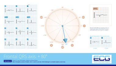 Ön QRS ekseni + 80 'de konumlandığında, aVL kurşun ekseninin negatif tarafında ve kurşun aVL' deki QRS ana dalgası negatiftir. Uzuv kurşunundaki QRS dalgasının en yüksek genliği aVF kurşunudur..