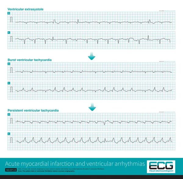 A patient with acute extensive anterior myocardial infarction developed ventricular arrhythmias during hospitalization. The ventricular arrhythmias worsened and the patient finally died of VF.