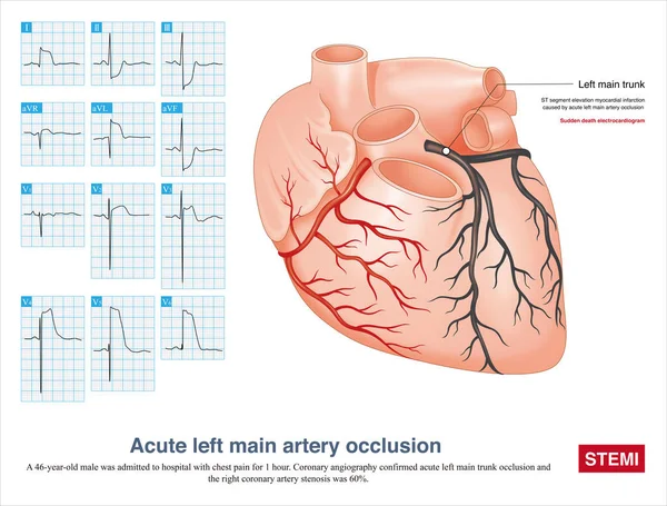 Acute left main artery occlusion can cause both ST segment elevation and non ST segment elevation myocardial infarction, regardless of which type, the risk of death is high.