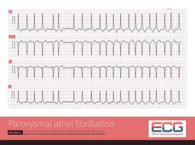 Taşikardi sendromu, bradikardi ve taşikardinin art arda tekrarlandığı özel bir türdür. Bu EKG, paroksismal atriyal fibrilasyon bölümleri kaydetti..