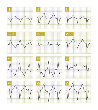 Genişlemiş kardiyomiyopatisi olan bir hastada ventriküler taşikardi vakası. Bu ventriküler taşikardi kalbin tepesinden kaynaklanır, V5 ve V6 'daki negatif QRS ana dalgası..
