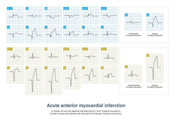 In some patients with acute anterior myocardial infarction, the inferior leads of the electrocardiogram will have ST segment depression, which is called corresponding ST segment depression.