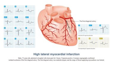 In acute high lateral myocardial infarction, there is indicative ST segment elevation in leads I and aVL, and corresponding ST segment depression in leads II, III and aVF. clipart