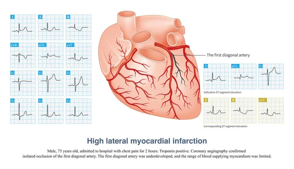 In acute high lateral myocardial infarction, there is indicative ST segment elevation in leads I and aVL, and corresponding ST segment depression in leads II, III and aVF.