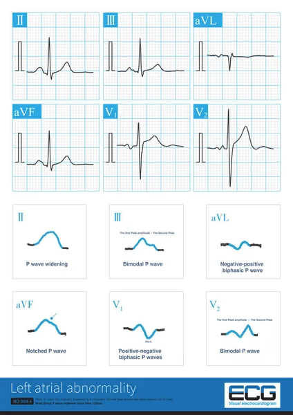 Alterações Eletrocardiográficas Anormalidade Átrio Esquerdo Incluem Alargamento Duração Onda Onda — Fotografia de Stock