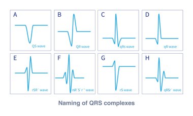 QRS dalgası, ventriküler depolarizasyondan oluşan bir elektrokardiyogramdır. Farklı dalga biçimlerine göre, farklı isimlendirme kuralları vardır. Bazıları anormal QRS dalgalarına ait..