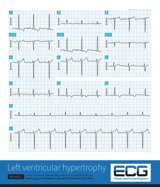 Sometimes, because the QRS axis is in the upper left quadrant, the high-amplitude R wave of left ventricular hypertrophy occurs in the limb leads, and left chest leads is normal. clipart